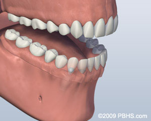 Denture Attached Santa Fe