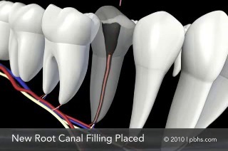 Root Canal Santa Fe