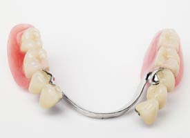 Partial Dentures Santa Fe Smiles TX